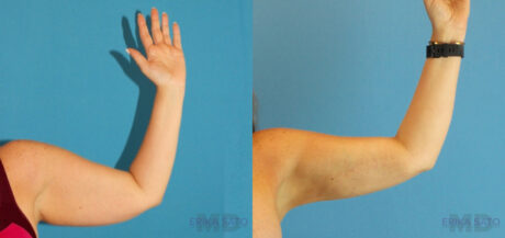Liposuction case #5963