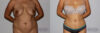 Liposuction case #5830 slider thumbnail