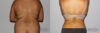 Liposuction case #5830 slider thumbnail