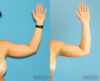 Liposuction case #5962 slider thumbnail