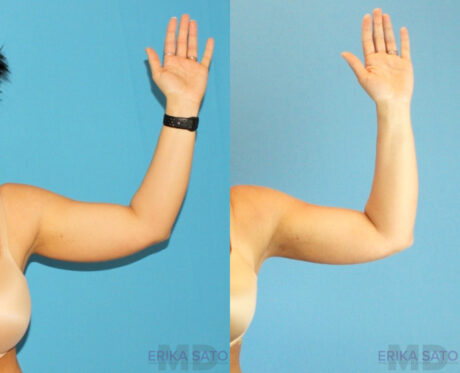 Liposuction case #5962