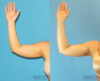 Liposuction case #5962 slider thumbnail