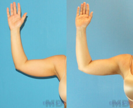 Liposuction case #5962