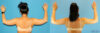 Liposuction case #5962 slider thumbnail