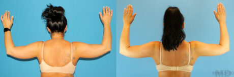 Liposuction case #5962