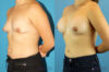 Breast Augmentation case #6262 slider thumbnail