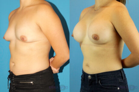 Breast Augmentation case #6262