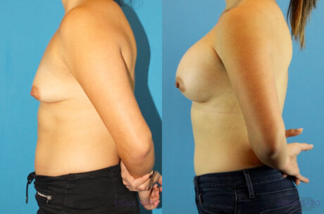 Breast Augmentation case #6262