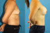Breast Augmentation case #6262 slider thumbnail