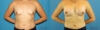 Breast Augmentation case #6262 slider thumbnail