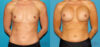 Breast Augmentation case #6273 slider thumbnail