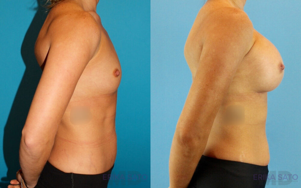 Breast Augmentation case #6273