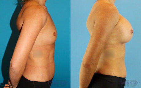 Breast Augmentation case #6273