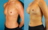 Breast Augmentation case #6273 slider thumbnail