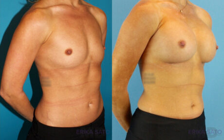 Breast Augmentation case #6273