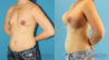 Breast Augmentation case #6268 slider thumbnail