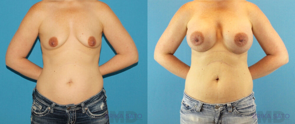 Breast Augmentation case #6268