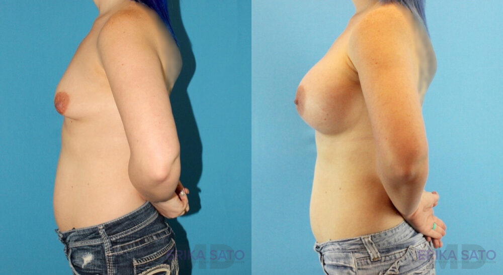 Breast Augmentation case #6268