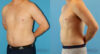 Liposuction case #5965 slider thumbnail