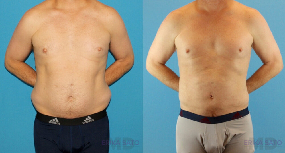 Liposuction case #5965