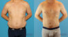 Liposuction case #5965 slider thumbnail