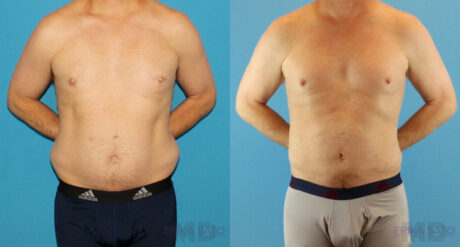 Liposuction case #5965