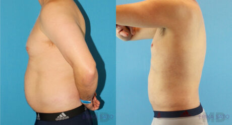 Liposuction case #5965
