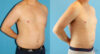 Liposuction case #5965 slider thumbnail