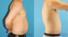 Liposuction case #5965 slider thumbnail