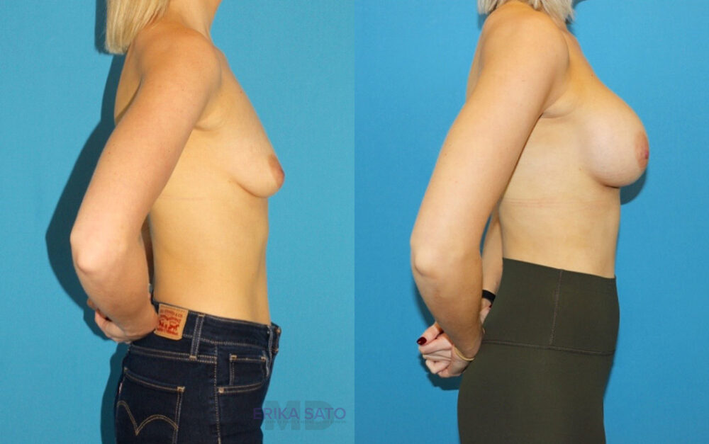 Breast Augmentation case #6279