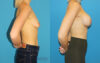 Breast Augmentation case #6279 slider thumbnail
