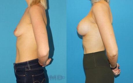 Breast Augmentation case #6279