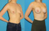 Breast Augmentation case #6279 slider thumbnail