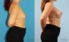 Breast Augmentation case #6285 slider thumbnail