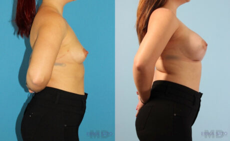 Breast Augmentation case #6285