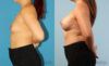 Breast Augmentation case #6285 slider thumbnail