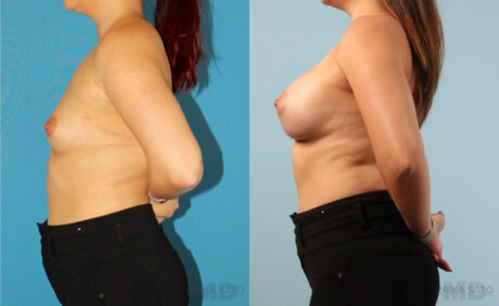 Breast Augmentation case #6285