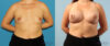 Breast Augmentation case #6285 slider thumbnail