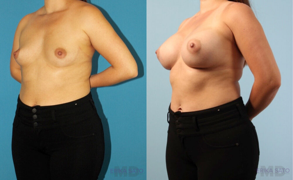 Breast Augmentation case #6285