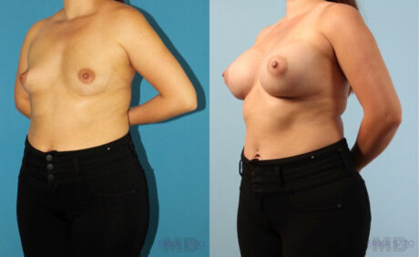 Breast Augmentation case #6285