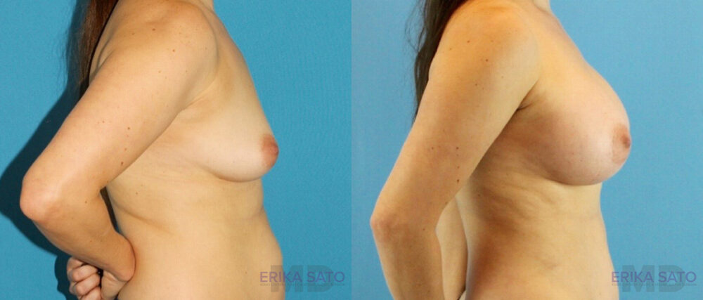 Breast Augmentation case #6291