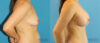 Breast Augmentation case #6291 slider thumbnail