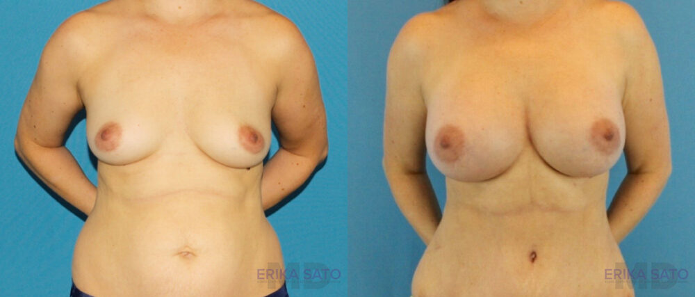 Breast Augmentation case #6291