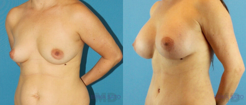Breast Augmentation case #6291