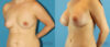 Breast Augmentation case #6291 slider thumbnail