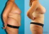 Mommy Makeover case #6511 slider thumbnail