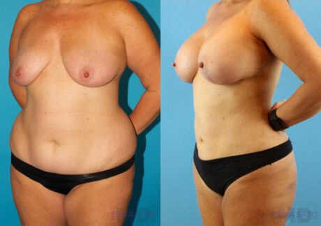Mommy Makeover case #6511