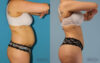 Brazilian Butt Lift case #4821 slider thumbnail