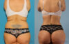 Brazilian Butt Lift case #4821 slider thumbnail