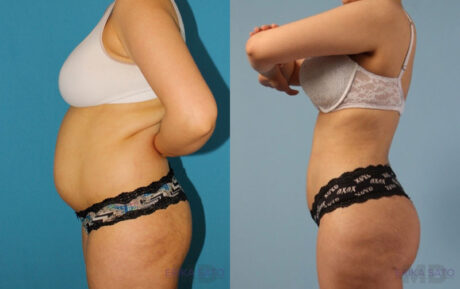 Brazilian Butt Lift case #4821